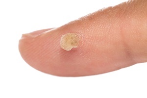 A wart is a skin disease that effectively combats Skincell Pro